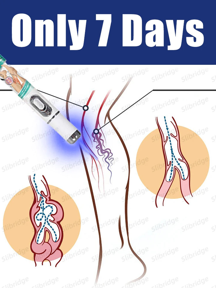 Leg Care Blue Light Therapy Pen – Varicose Vein Treatment Tool, 2025 Hot Sale